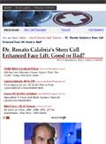 Article: Dr. Renato Calabria's Stem Cell Enhanced Face Lift